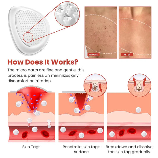 Skin Tag Remover Patches – Discreet, Easy‑Apply Strips